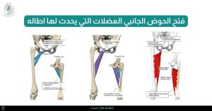 _فتح الحوض الجانبي العضلات التي يحدث لها اطاله ١